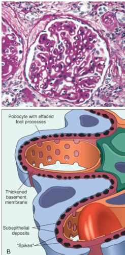 membranous glomerulonephritis spike and dome|Membranous nephropathy: Clearer pathology and mechanisms .